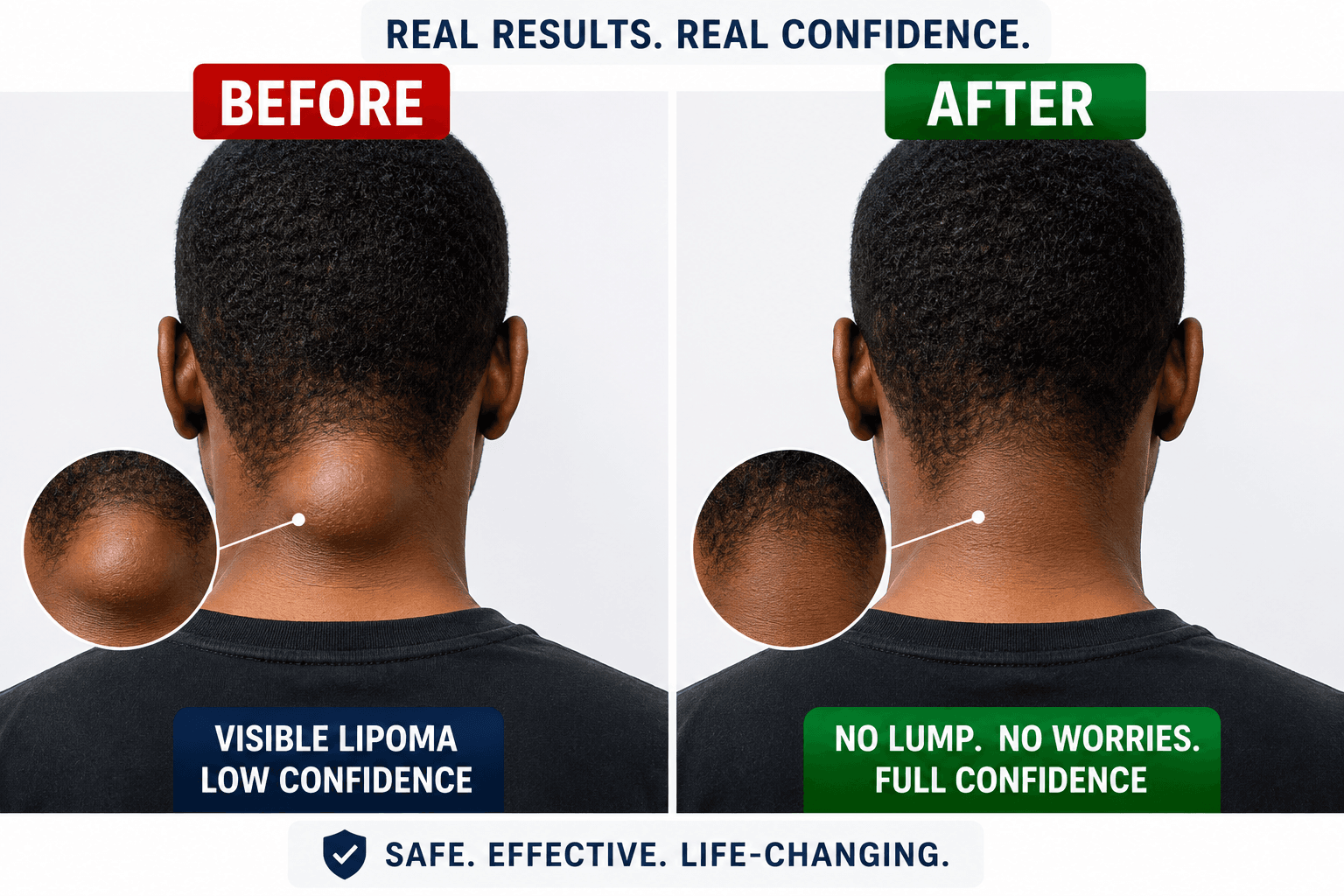 Before and after using the lipoma treatment cream