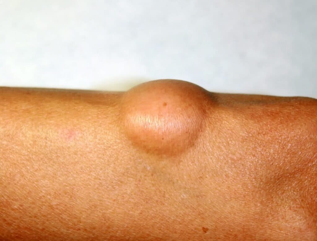 A lipoma forming under the skin