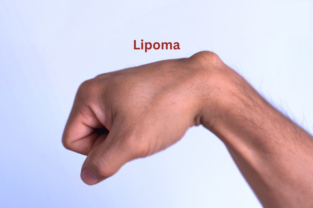 A lipoma on the body